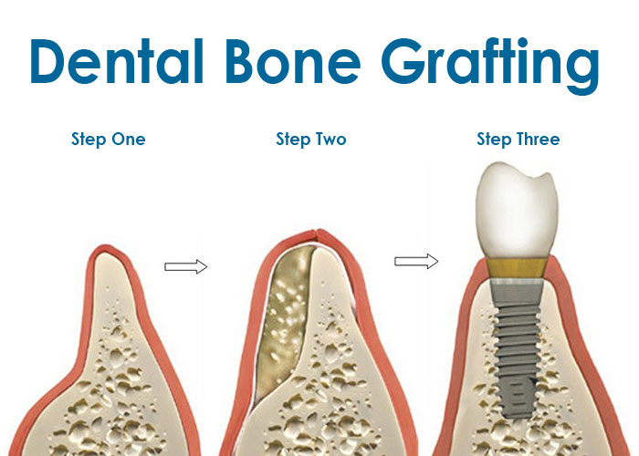 Bone Graftingvancouver General Dentistry Dr David Huh Four Seasons Dental Care Burnaby